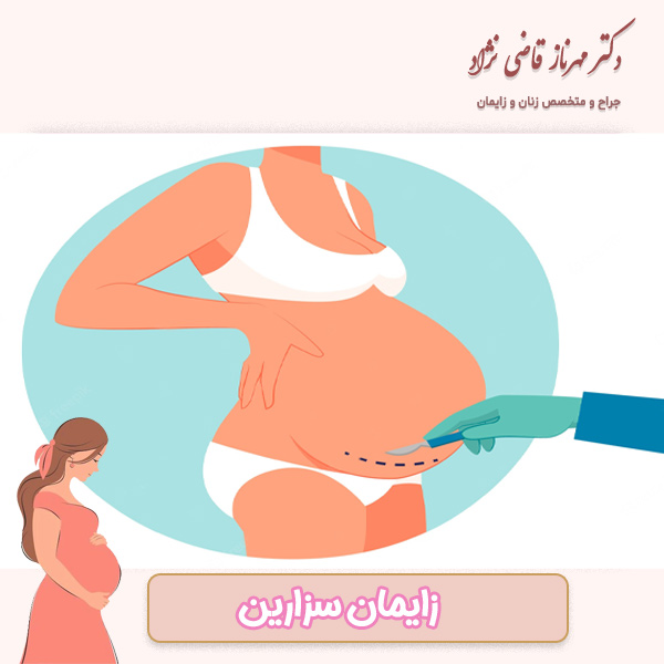 زایمان سزارین - دکتر قاضی نژاد