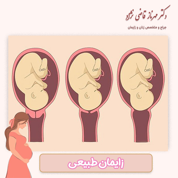زایمان طبیعی - دکتر مهرناز قاضی نژاد