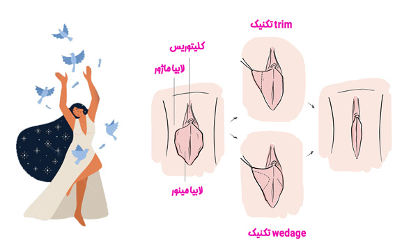لابیاپلاستی - دکتر قاضی نژاد