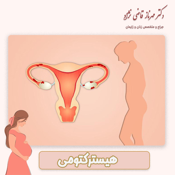 هیسترکتومی - دکتر قاضی نژاد