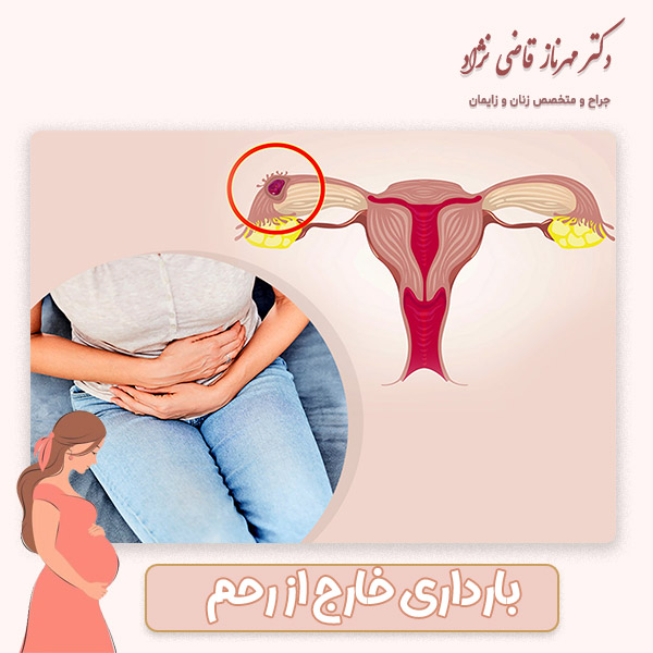 بارداری خارج از رحم - دکتر قاضی نژاد