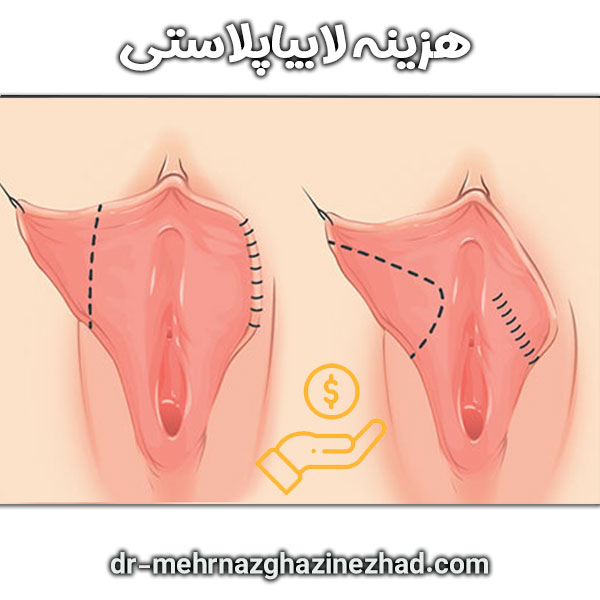هزینه لابیاپلاستی دکتر مهرناز قاضی نژاد در شوشتر