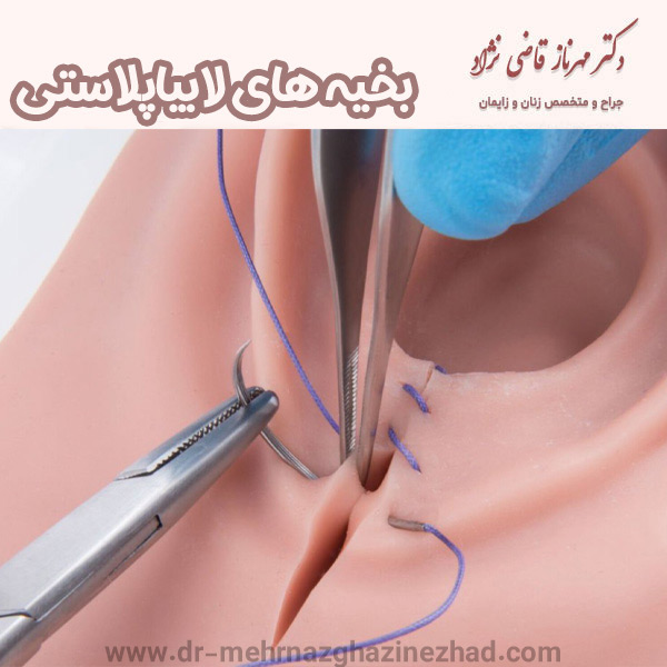 بخیه های لابیاپلاستی - https://dr-mehrnazghazinezhad.com/