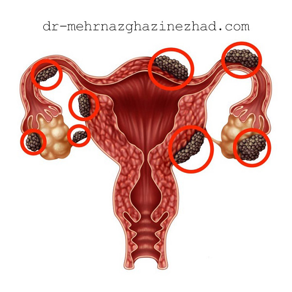 Endometriosis-mehrnazghazinezhad-com