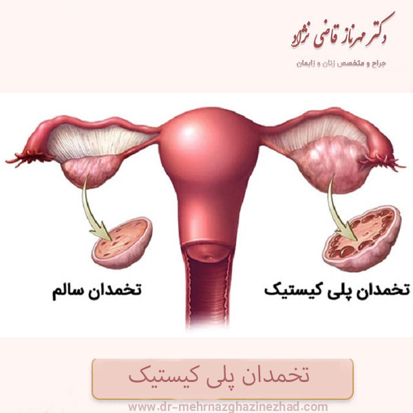 سندروم تخمدان پلی کیستیک