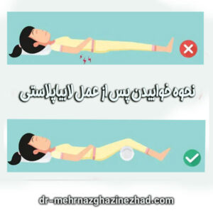 نحوه خوابیدن بعد از لابیاپلاستی از بهترین جراح لابیاپلاستی در شوشتر