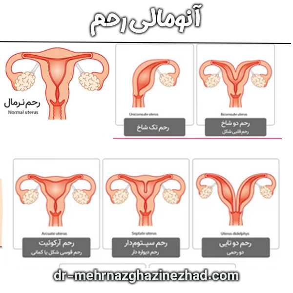 آنومالی رحم از دکتر قاضی نژاد ، بهترین دکتر زنان شوشتر