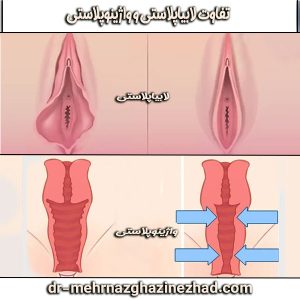 تفاوت لابیاپلاستی و واژینوپلاستی از دکتر مهرناز قاضی نژاد ، بهترین جراح لابیاپلاستی در شوشتر 