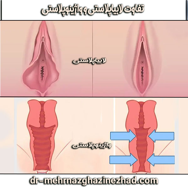 تفاوت لابیاپلاستی و واژینوپلاستی از دکتر مهرناز قاضی نژاد ، بهترین جراح لابیاپلاستی در شوشتر