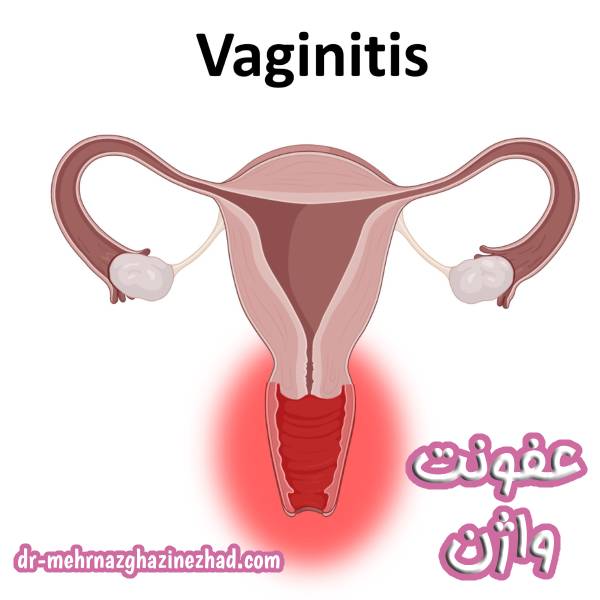 عفونت واژن