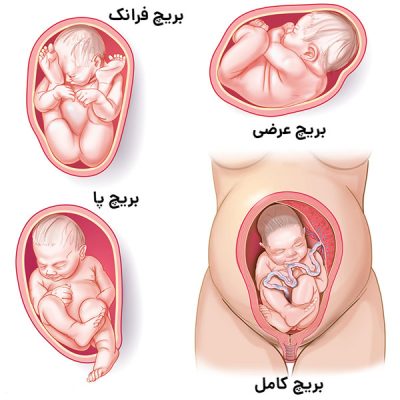 زایمان بریچ - دکتر قاضی نژاد