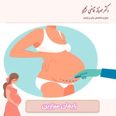 زایمان سزارین - دکتر قاضی نژاد
